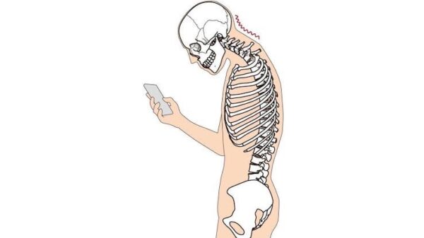 ストレートネックとは？原因と対策、肩こり・頭痛との関係 画像